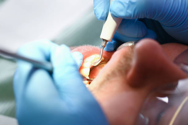 Best Emergency Dentist for Knocked-Out Tooth in Ocean Springs, MS
